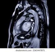 Heart MRI