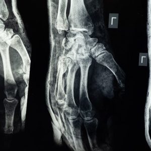 Joint X-Ray
