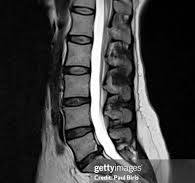 Lumber MRI