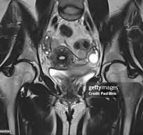 Pelvic MRI